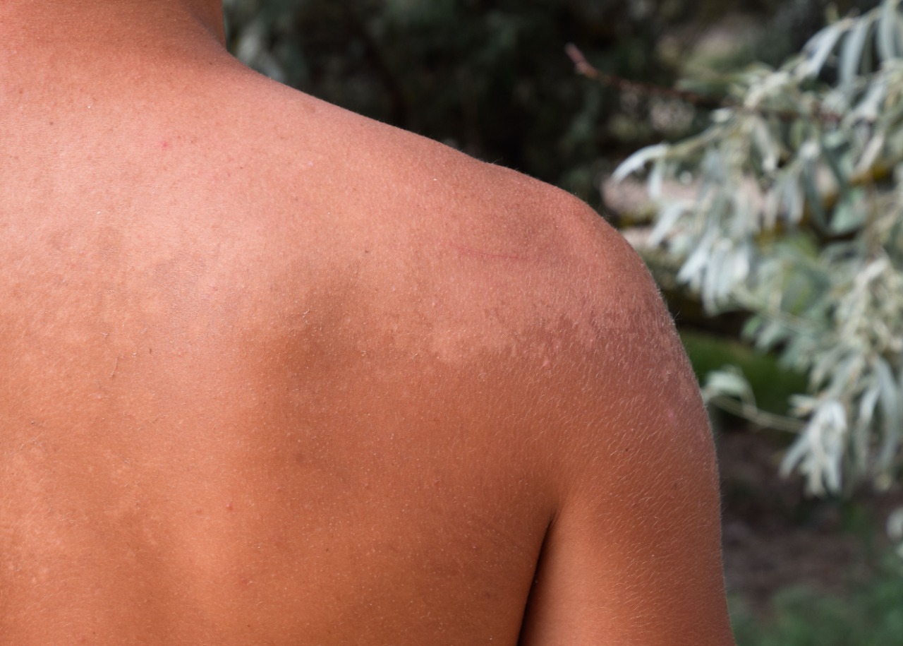 Amor Cantado hanseníase