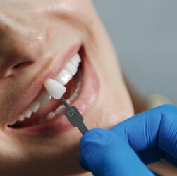 Aplicação de facetas dentárias exigem técnica especializado