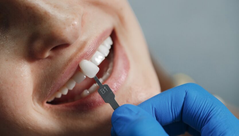 Aplicação de facetas dentárias exigem técnica especializado