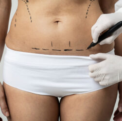 Lipoaspiração é a cirurgia estética mais realizada no mundo