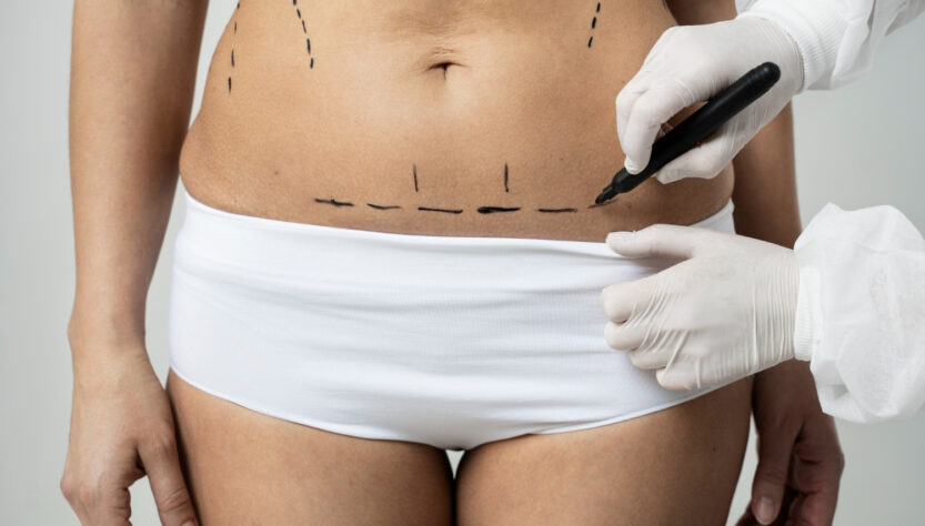 Lipoaspiração é a cirurgia estética mais realizada no mundo