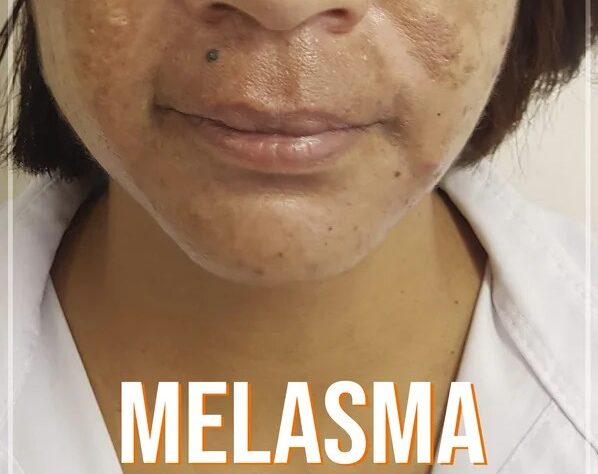 Melasma pode ser tratado com ativos específicos