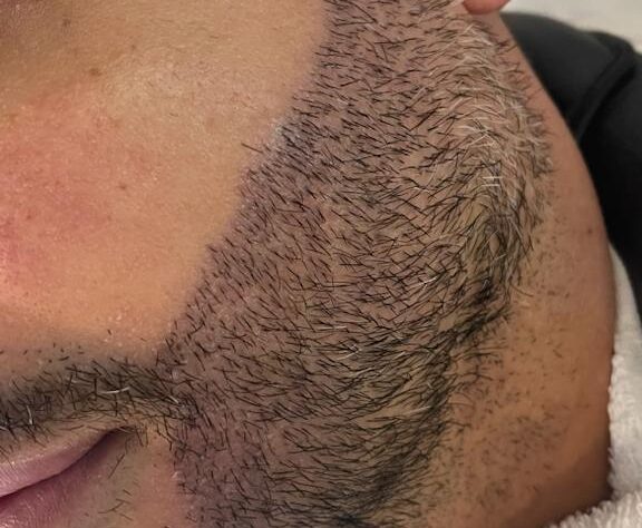 Transplante de barba cresce no mercado masculino