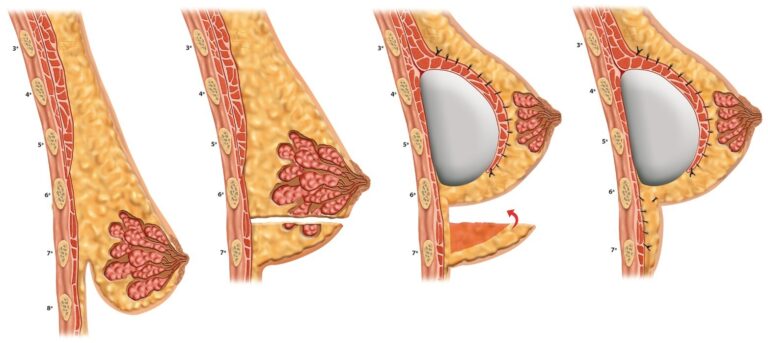 Técnica brasileira de mastopexia é sistematizada