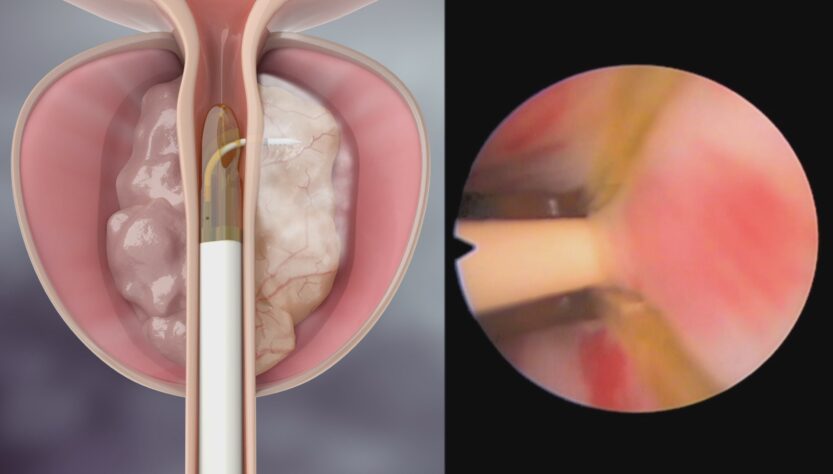 Tratamento de próstata: agora disponível em Bauru