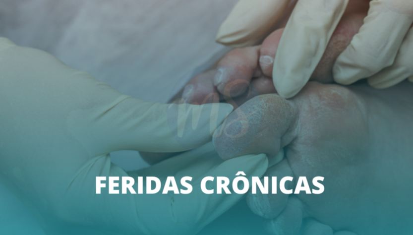 Estomaterapeuta trata ferida crônica e promove autocuidado eficaz