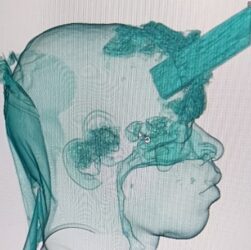 Médicos da Medplus Serviços Médicos no Hospital Municipalizado Adão Pereira Nunes realizaram uma cranioplastia no carpinteiro, Vitor Soares.