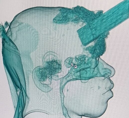 Médicos da Medplus Serviços Médicos no Hospital Municipalizado Adão Pereira Nunes realizaram uma cranioplastia no carpinteiro, Vitor Soares.